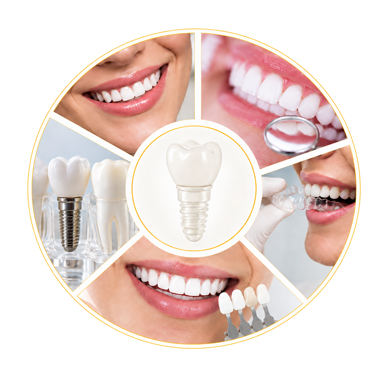 Composição com tratamentos odontológicos e implante dentário